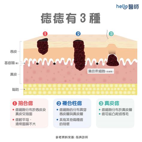 痣長毛|為什麼臉上的痣越來越多？皮膚科醫師解析長痣原因、。